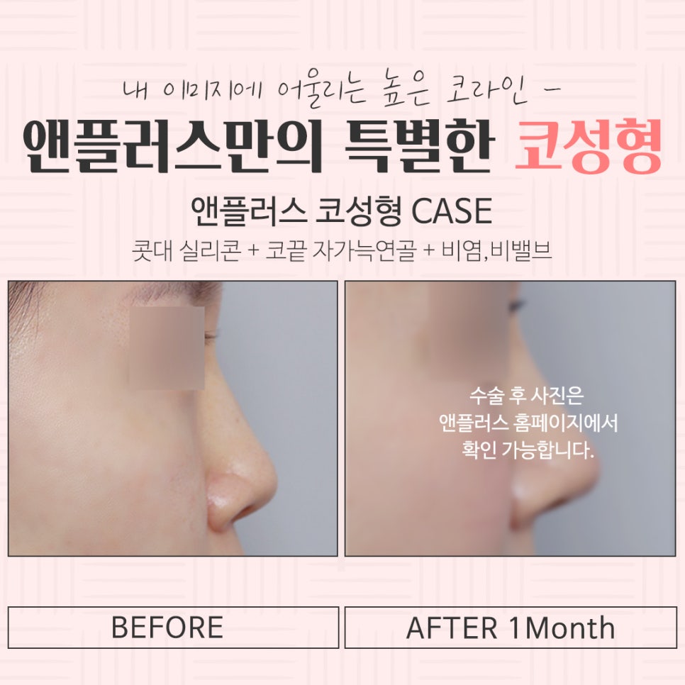 Checking Nose Surgery Reviews image 16