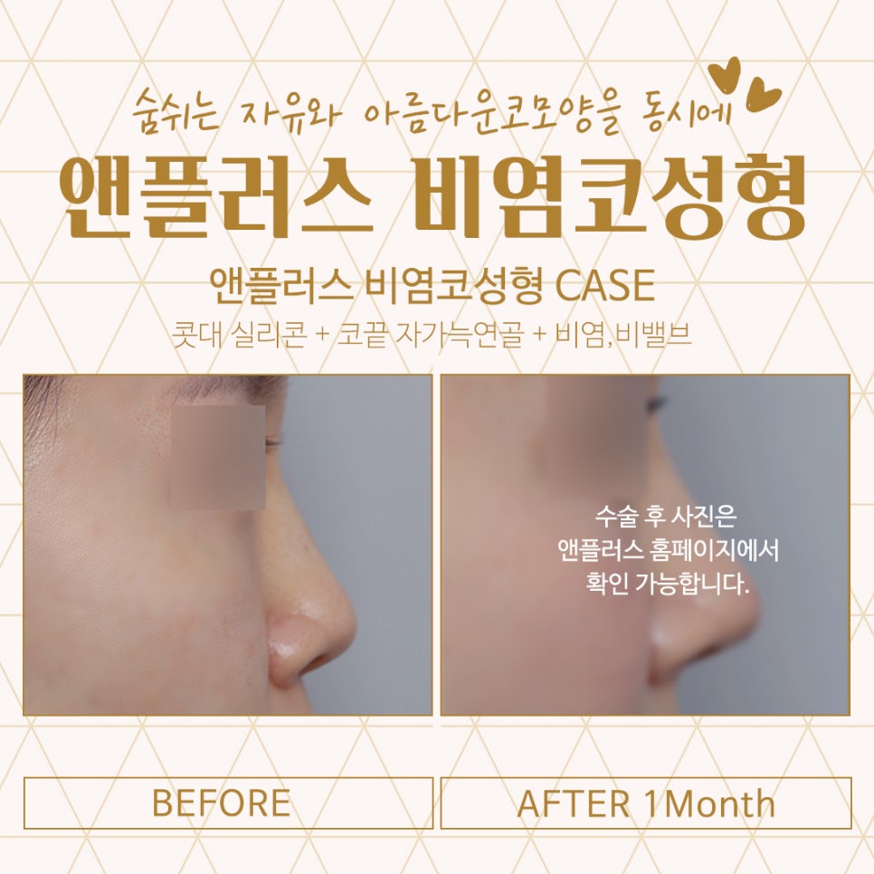비염코성형후기 예쁜코라인을 생각하면서 관련 이미지 5