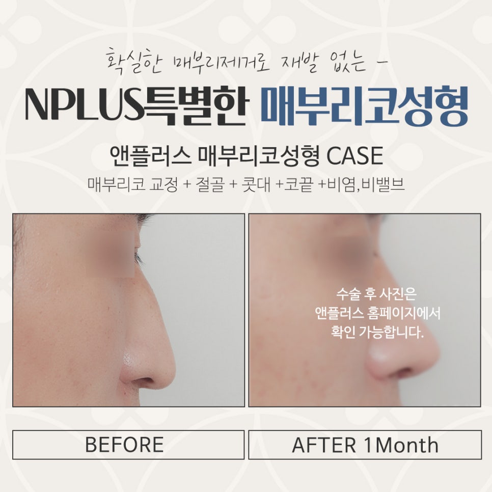 매부리코수술 후기까지 상세하게 알아보고 관련 이미지 16