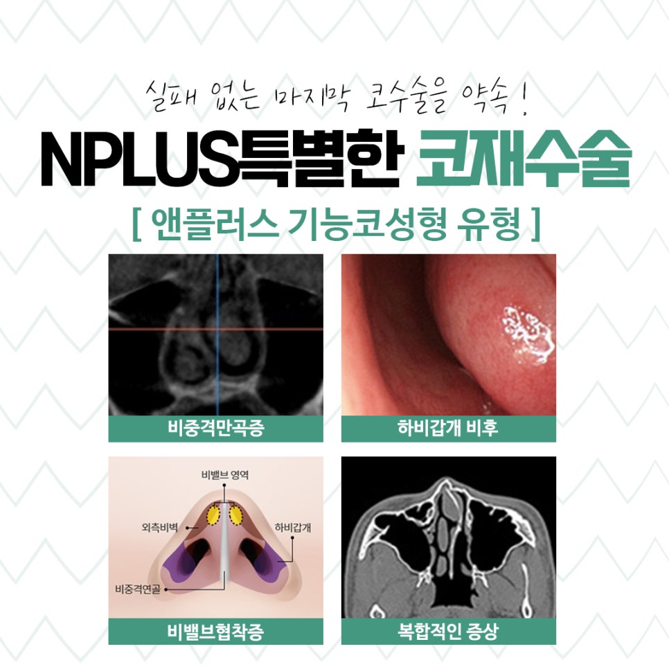 코재수술성형외과 신중하게 알아보고 관련 이미지 6