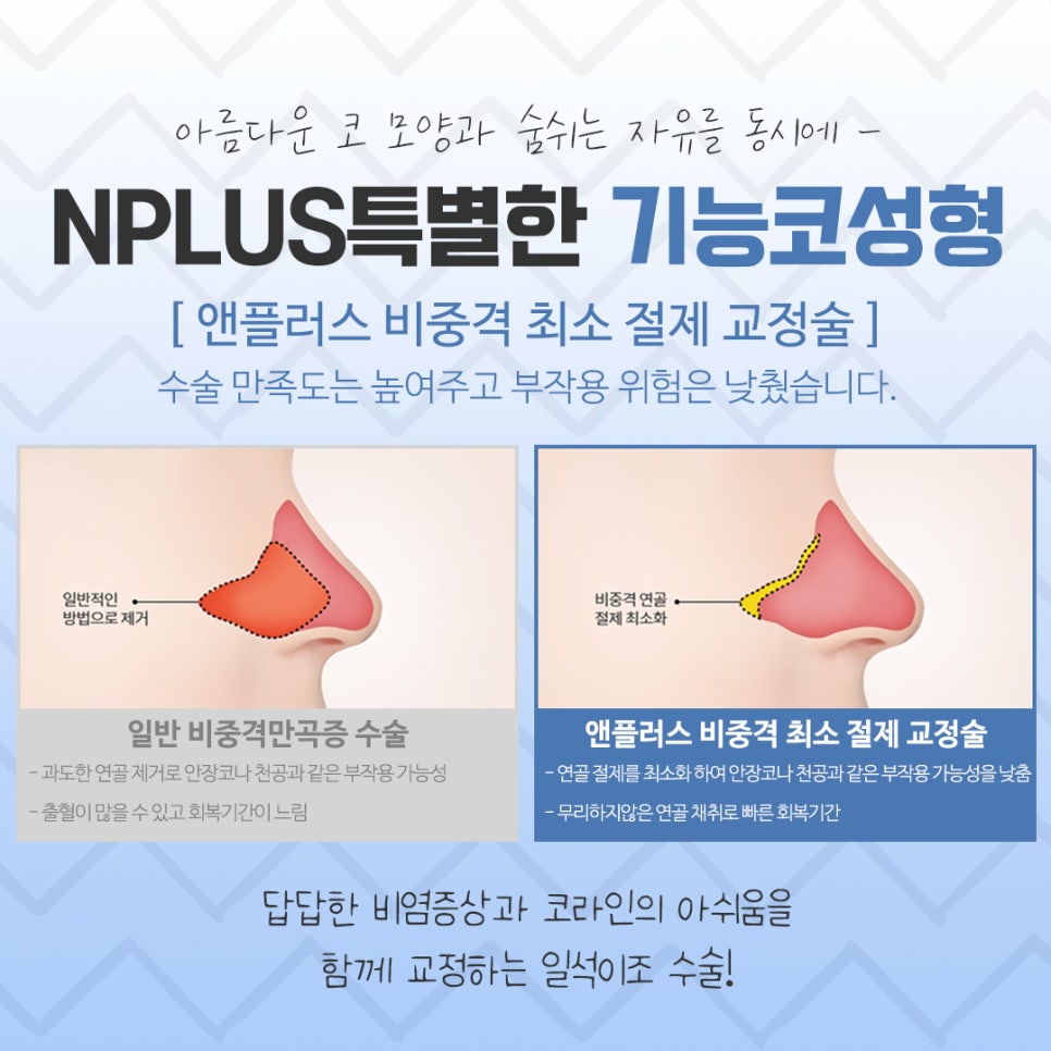 비염수술전후 확실한 차이를 알아보고 관련 이미지 9