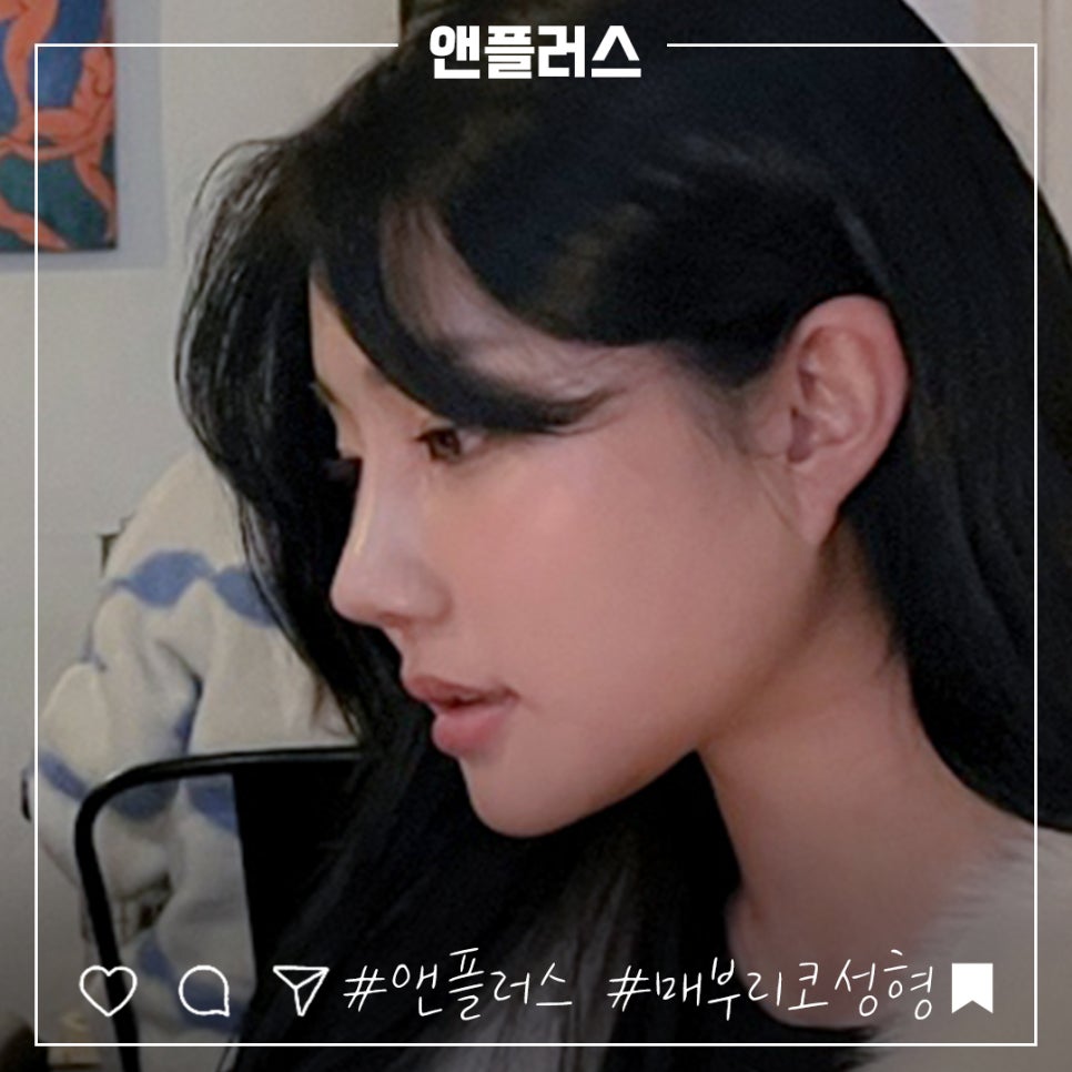 매부리코성형후기 정확한 진단을 통해 관련 이미지 2