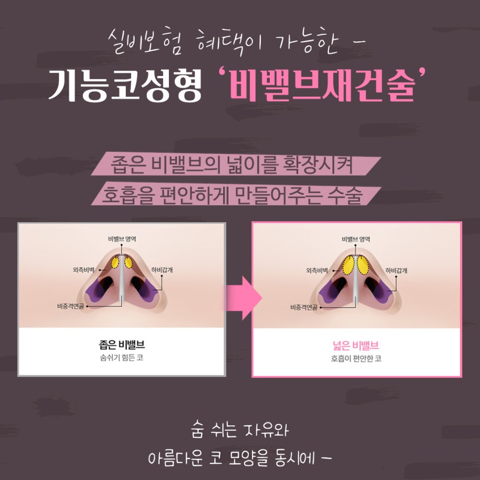 비밸브재건술 확실한 강남앤플러스에서 관련 이미지 8