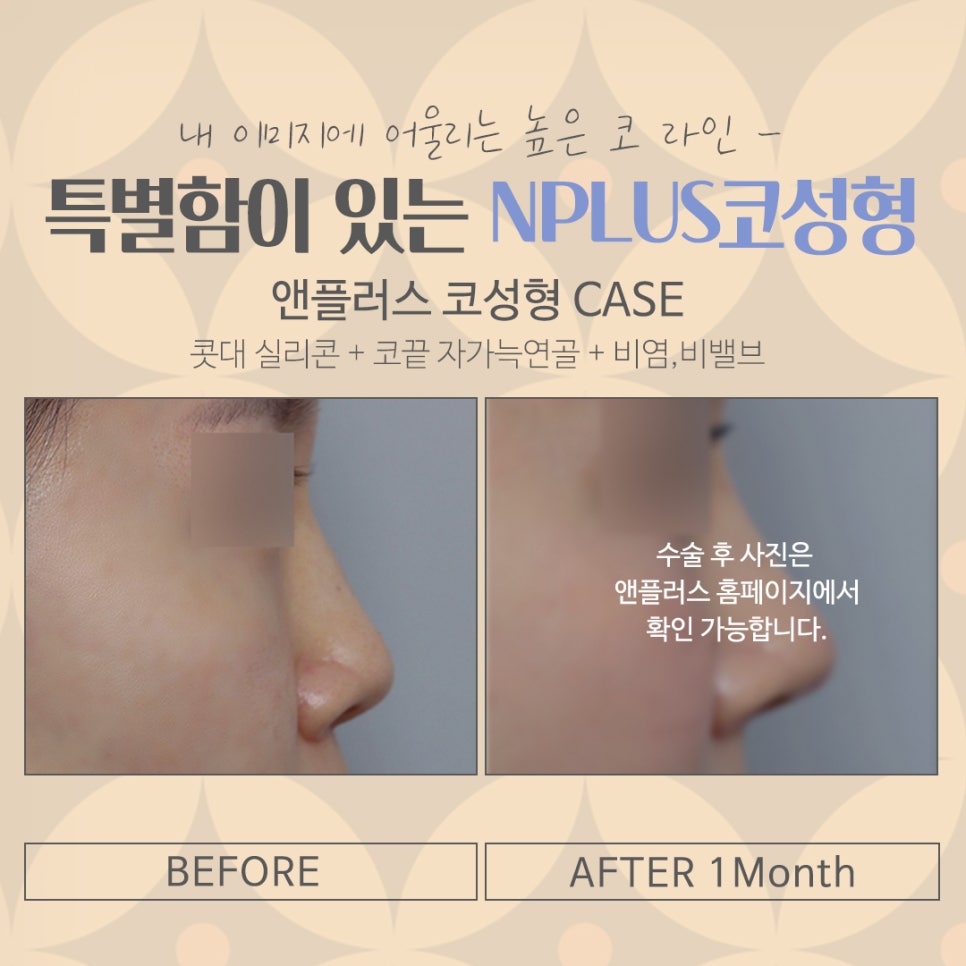 코성형후기 내부 기능까지 확실하게 관련 이미지 14