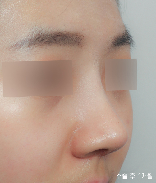 낮은코성형 비염수술도 예쁘게 관련 이미지 8