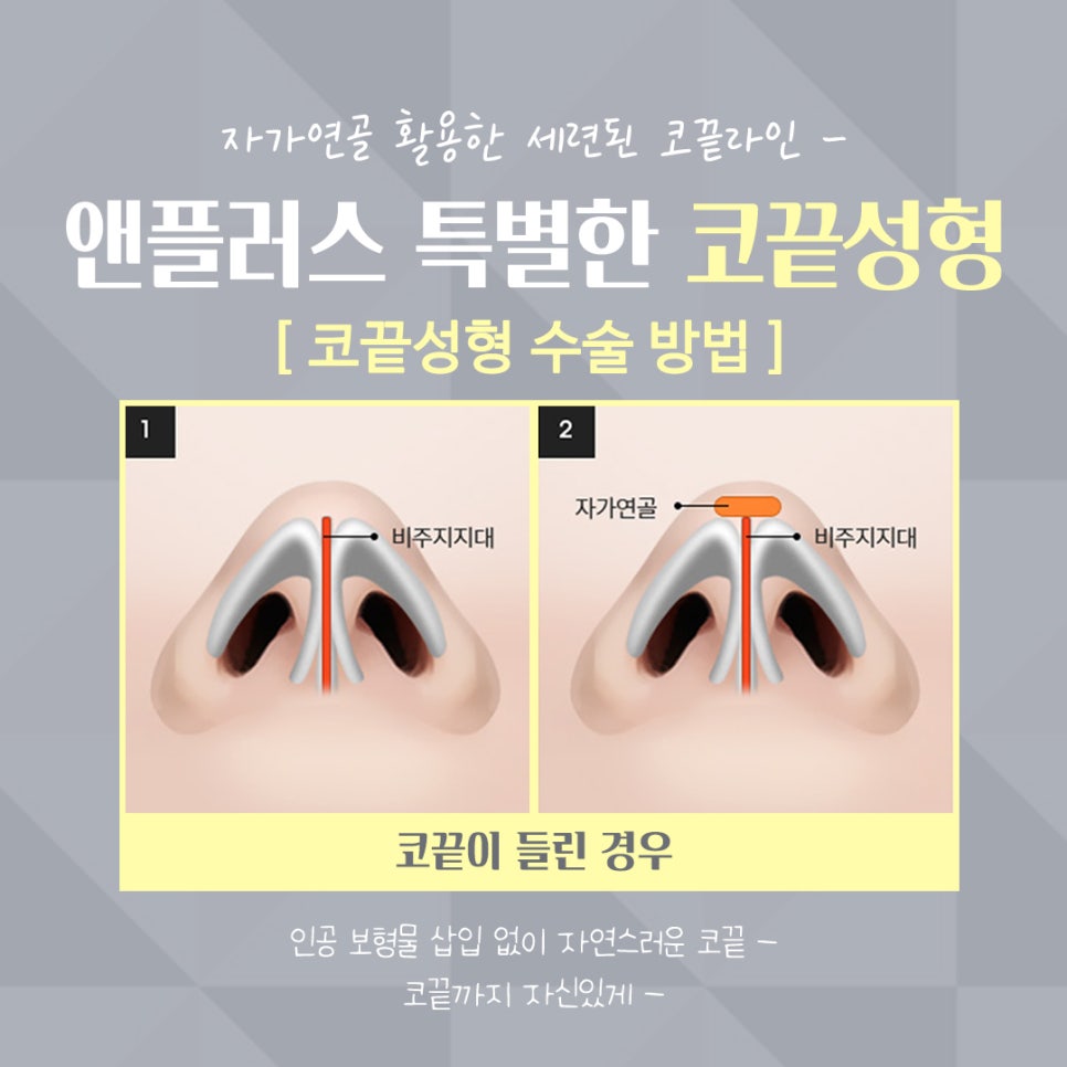Tip Plasty Through Tip Cartilage Stitching image 8