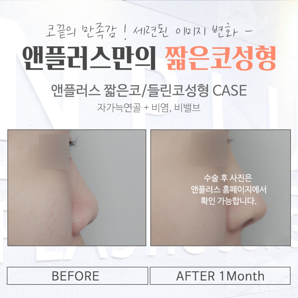 짧은코성형에 대한 차이를 알아보고 관련 이미지 15
