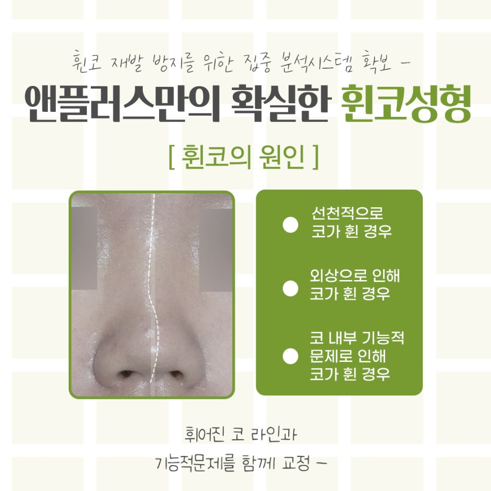 휜코수술에 대해 자세하게 확인하고 관련 이미지 4