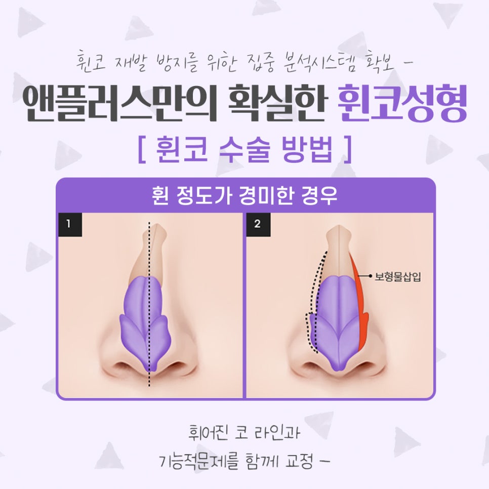 Bent Nose Surgery Review: With an Accurate Diagnosis image 9