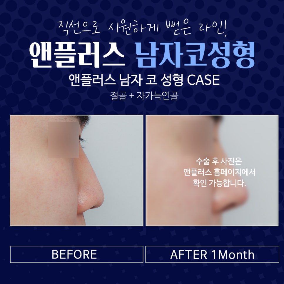 남자코성형전후 남자다운 직선라인으로 관련 이미지 6