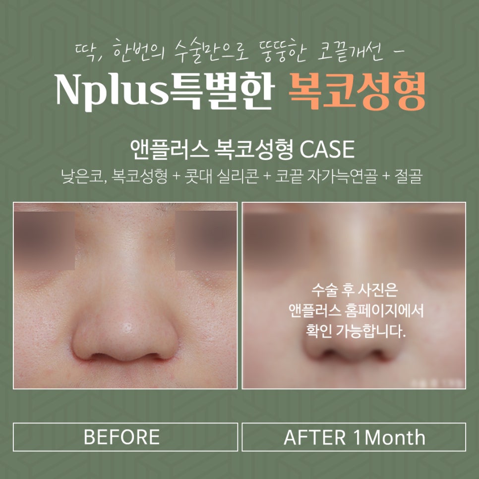 Rhinoplasty Review for a Bulbous Nose Through Nose Fat Removal image 5