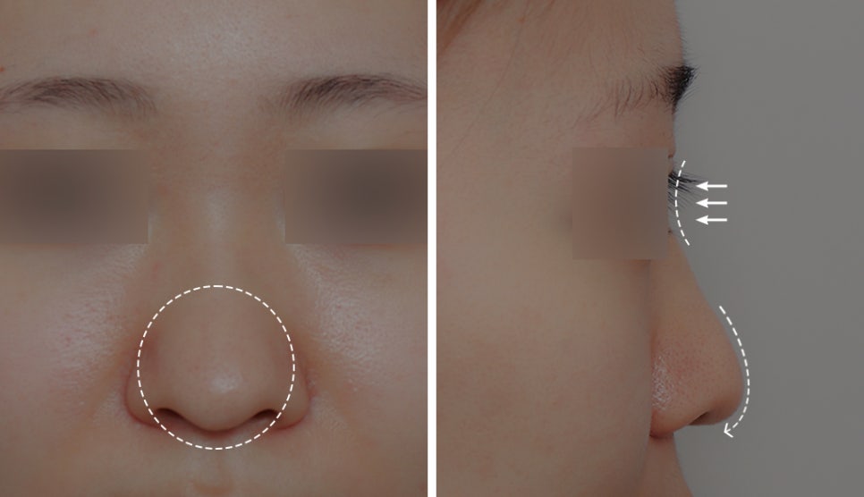 Creating a Straight-But-Slightly-Curved Nose Line with Columella Reduction image 1
