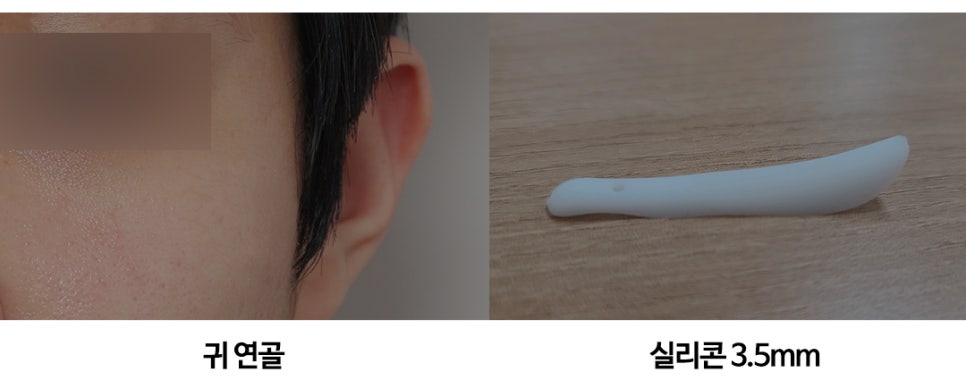 남자매부리코_비염수술과 동시에 관련 이미지 8