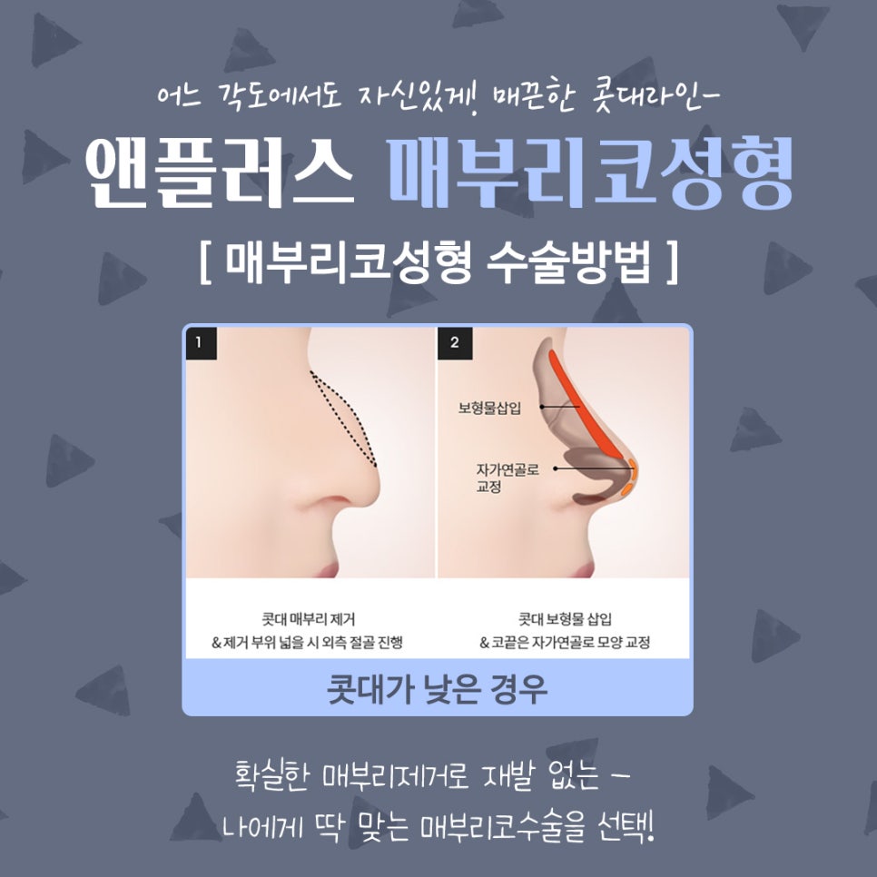 남자매부리코성형 기능까지 고려해서 관련 이미지 8