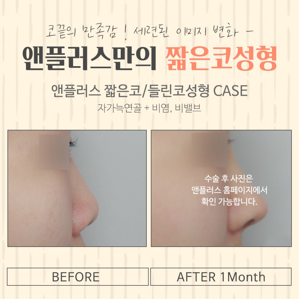 짧은코수술에 대한 정보를 찾는다면 관련 이미지 17