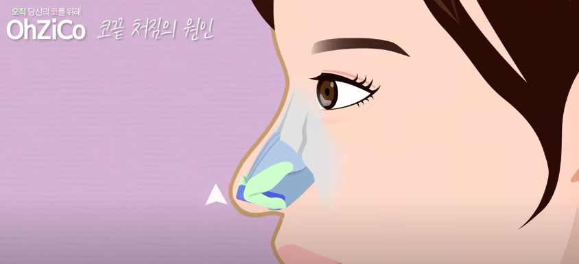 코성형 후 코끝처짐 원인과 해결 방법 관련 이미지 9