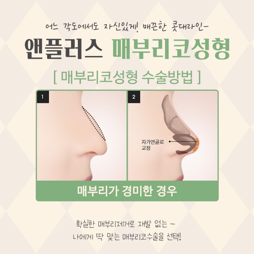 매부리코교정으로 달라진 전후를 확인하고 관련 이미지 11