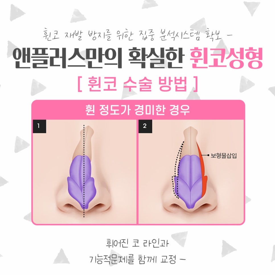 휜코수술후기를 자세하게 알아보고 관련 이미지 7