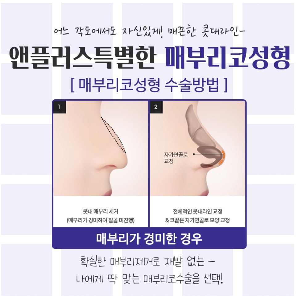 An Image Changed by Hump Nose Surgery Reviews image 11