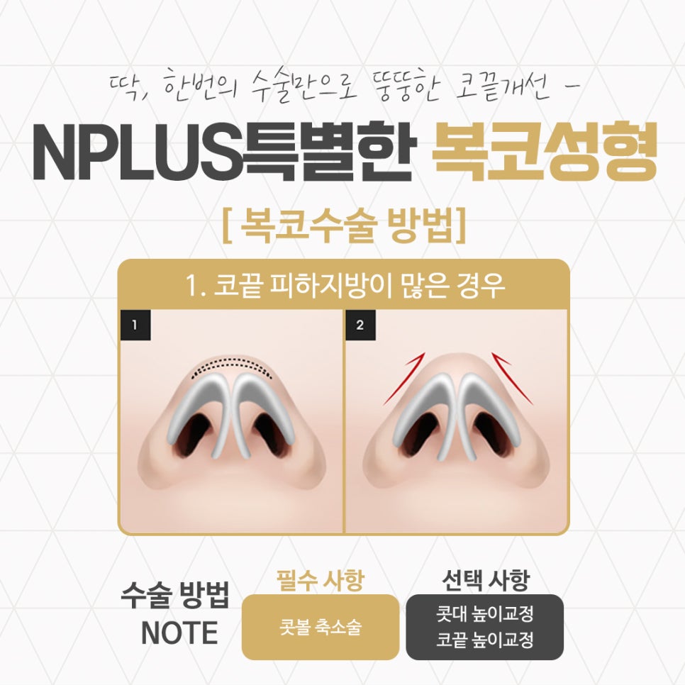 Understanding the Cause of Bulbous Nose Surgery Accurately image 8
