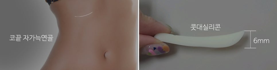 Upturned Nose Surgery_Naturally with Tip Lengthening image 4