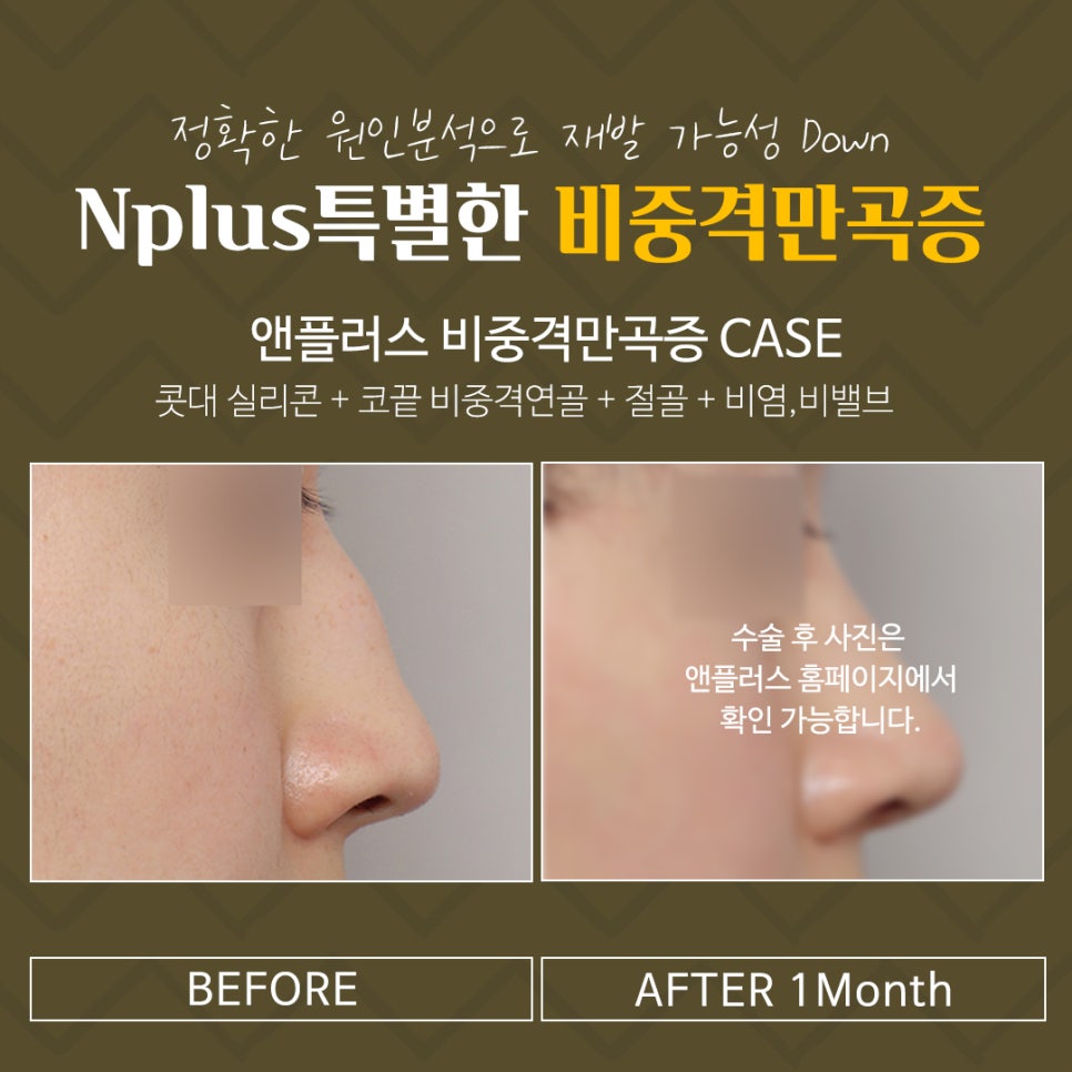 Septoplasty Methods and Causes image 12