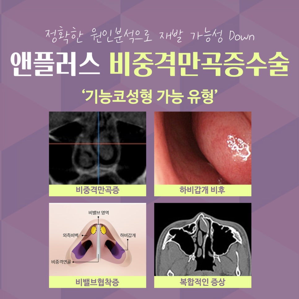 비중격만곡증수술후기 라인까지 고려해서 관련 이미지 5
