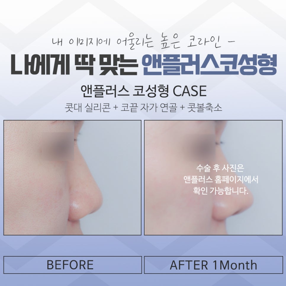 압구정코성형에서 자연스럽게 개선 관련 이미지 14
