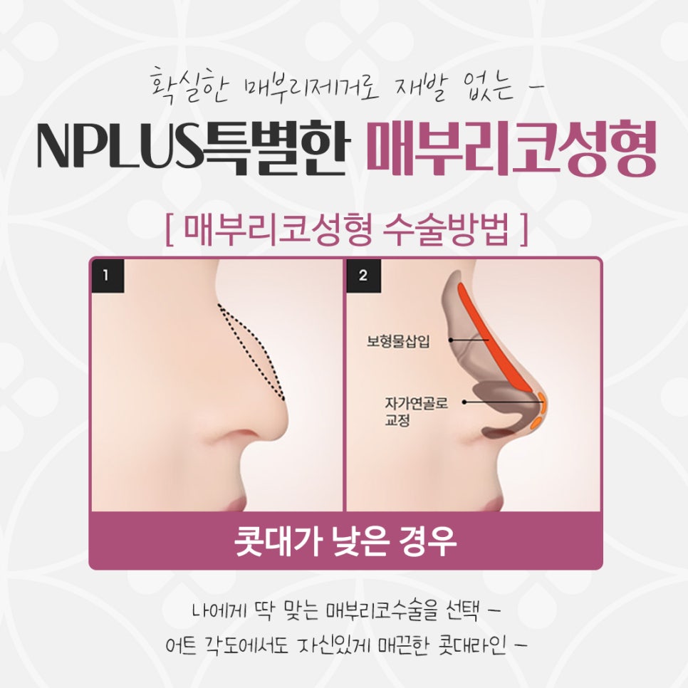 매부리코수술후기 예쁜코라인으로 관련 이미지 11