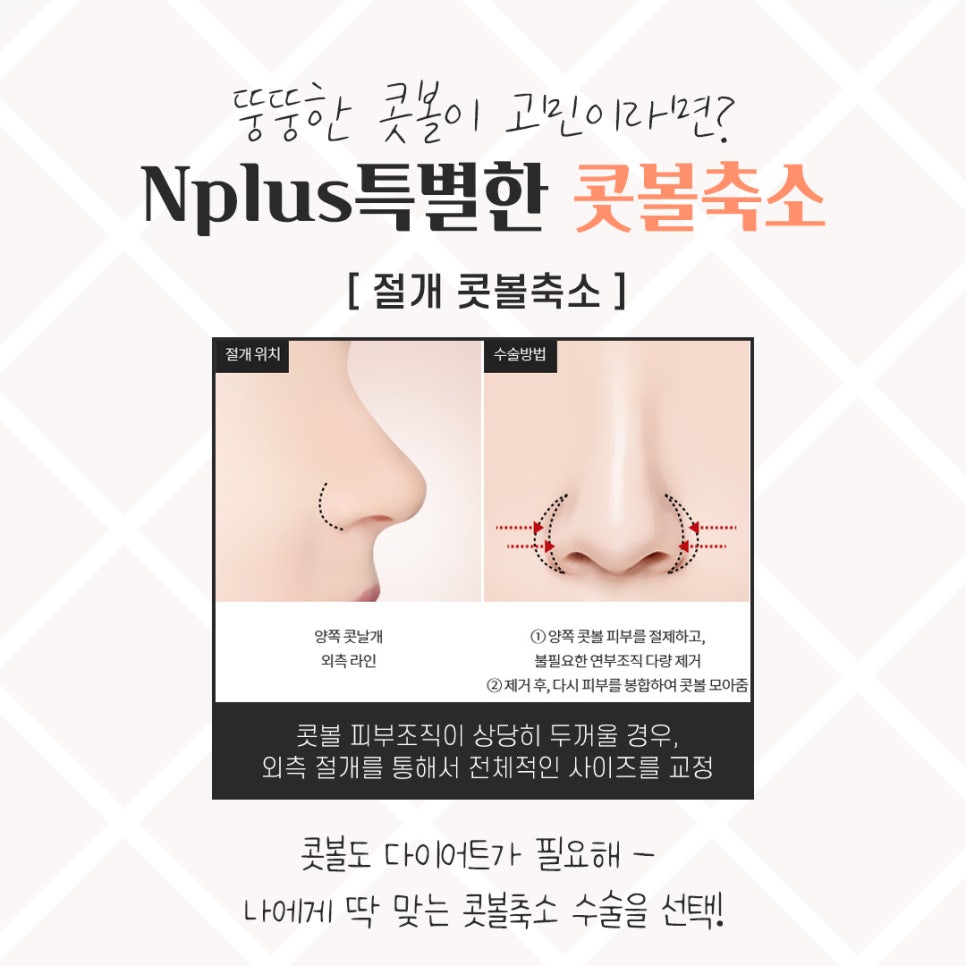 Looking Closely at Nostril Reduction Reviews image 9