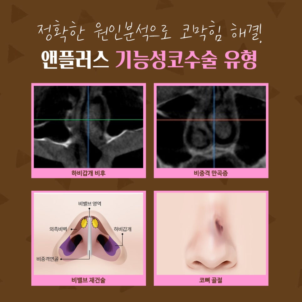 비중격만곡증수술후기 코막힘 고민 해결 관련 이미지 7