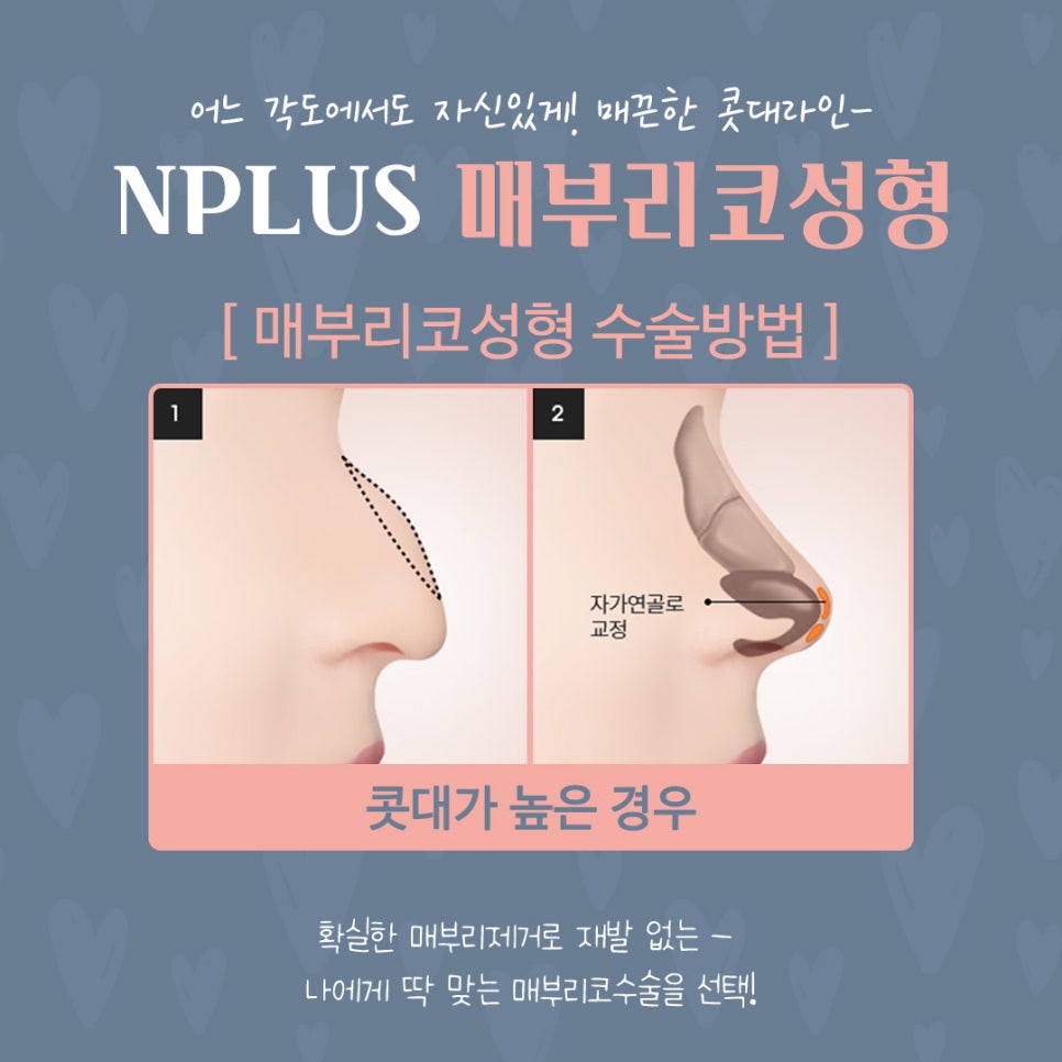 매부리코수술 후기까지 확인하고 관련 이미지 10