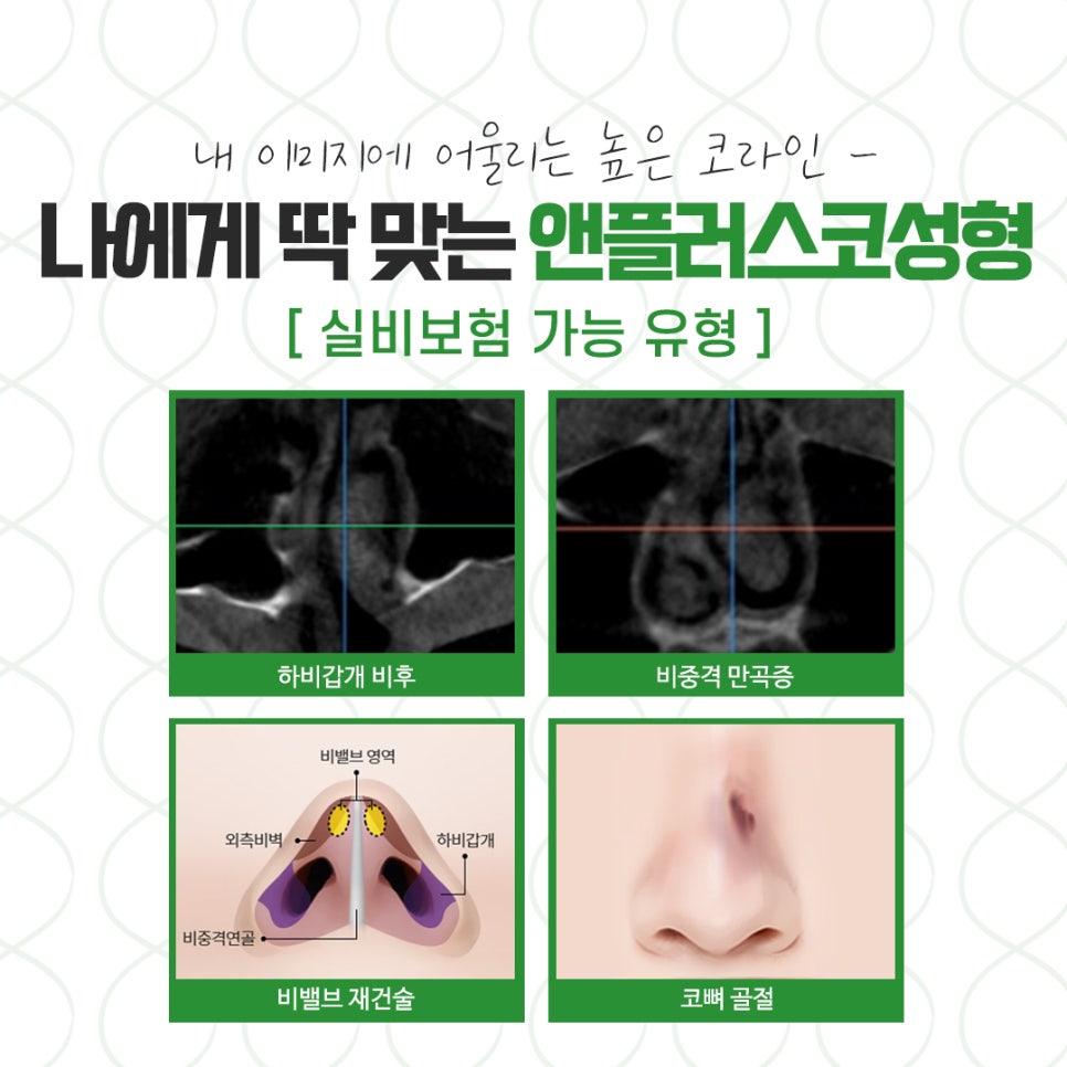 코뼈골절 다양한 방법으로 관련 이미지 5