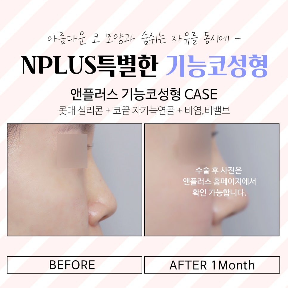 코수술후기에 대해 정확하게 진단하여 관련 이미지 13