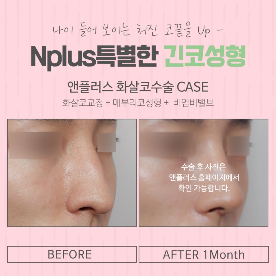 긴코성형으로 교정하고 동안 되자 관련 이미지 16