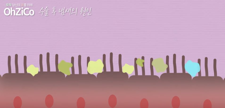코수술 후 코냄새 원인과 해결 방법! 관련 이미지 9
