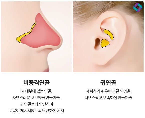늑연골 코성형 : 자가연골의 장점과 단점 (자가연골 비교) 관련 이미지 3