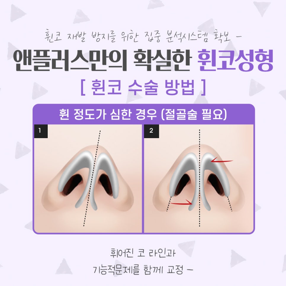 Bent Nose Surgery Review: With an Accurate Diagnosis image 10
