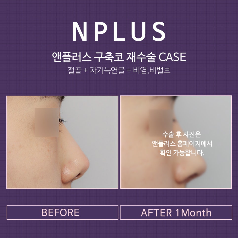 Contracted Nose Surgery_ Make Your Last Nose Surgery More Satisfying image 10