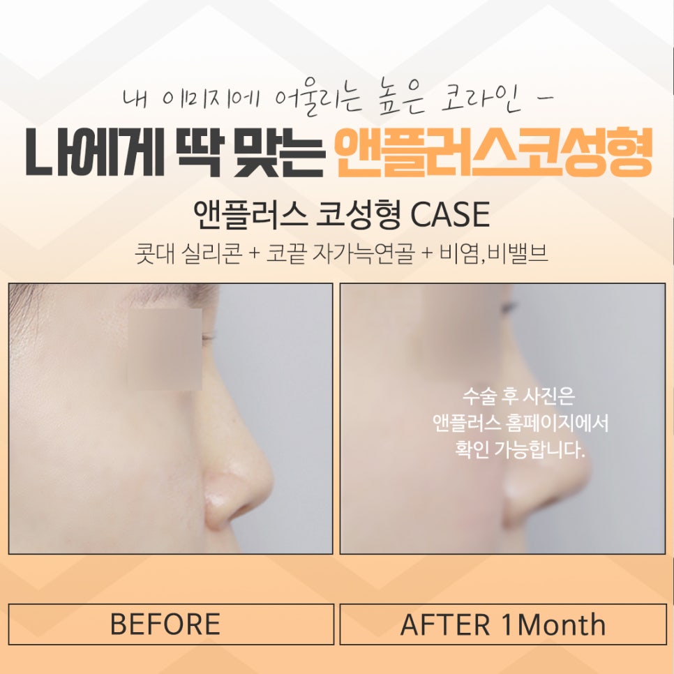 코수술후기에 대해 자세히 찾아보고 관련 이미지 17