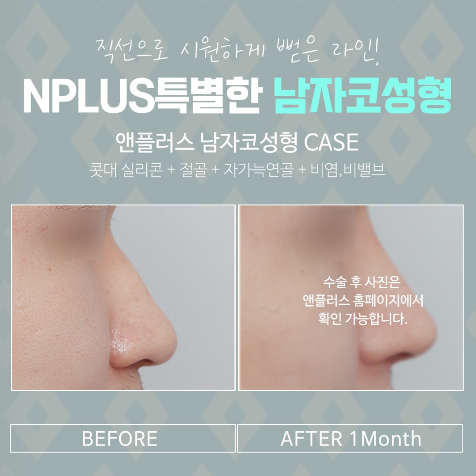 남자코수술전후 꼼꼼하게 체크하고 관련 이미지 5