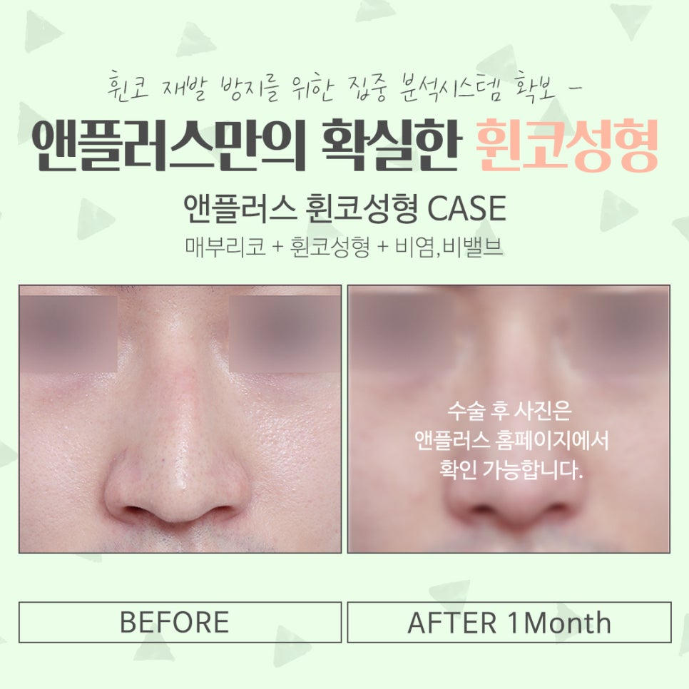 휜코성형후기 자세하게 알아보고 관련 이미지 16