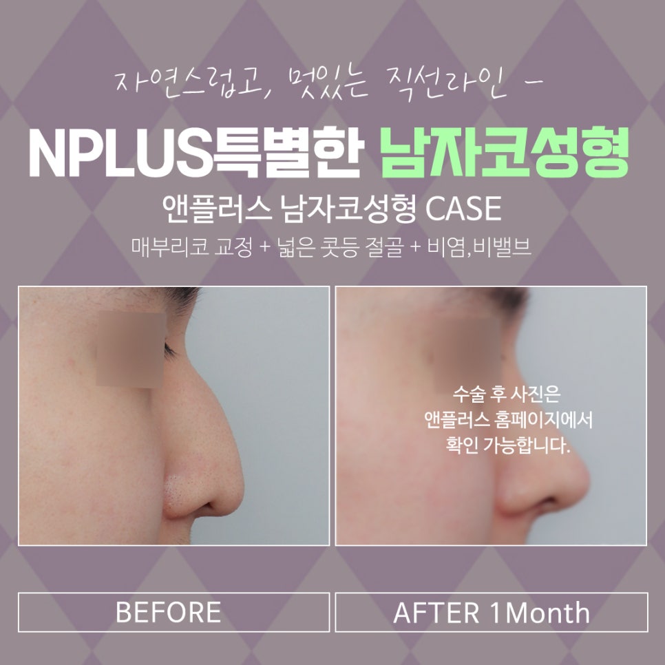 남자코성형후기 변화된 이미지를 확인 관련 이미지 14