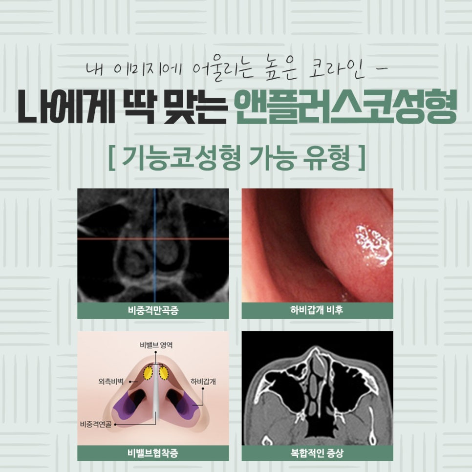 자가연골코수술로 세련되고 자연스럽게 관련 이미지 11