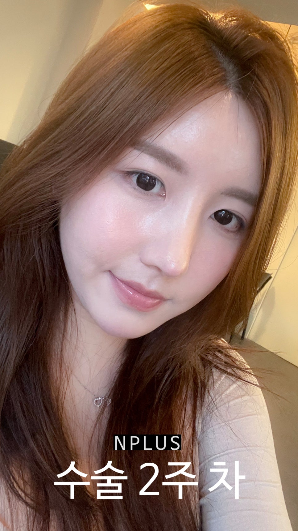 Short and Upturned Nose Shape Corrected with Autologous Rib Cartilage Nose Surgery at N Plus Clinic! image 5