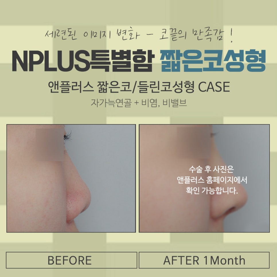 짧은코성형을 통한 자신감 회복 관련 이미지 14