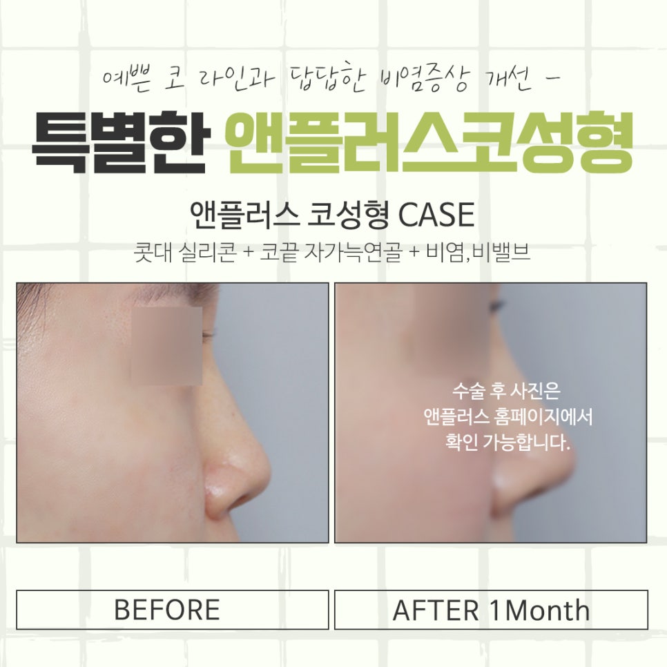 강남코성형에 대해 자세하게 알아보고 관련 이미지 14