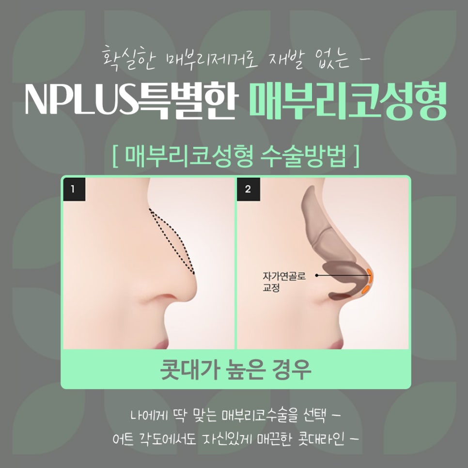 Septoplasty and Hump Nose Surgery Review, Considering Function Too image 9