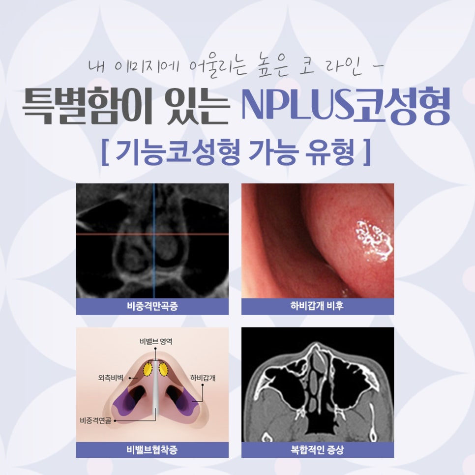 코성형잘하는곳에서 자연스럽고 예쁘게 관련 이미지 6