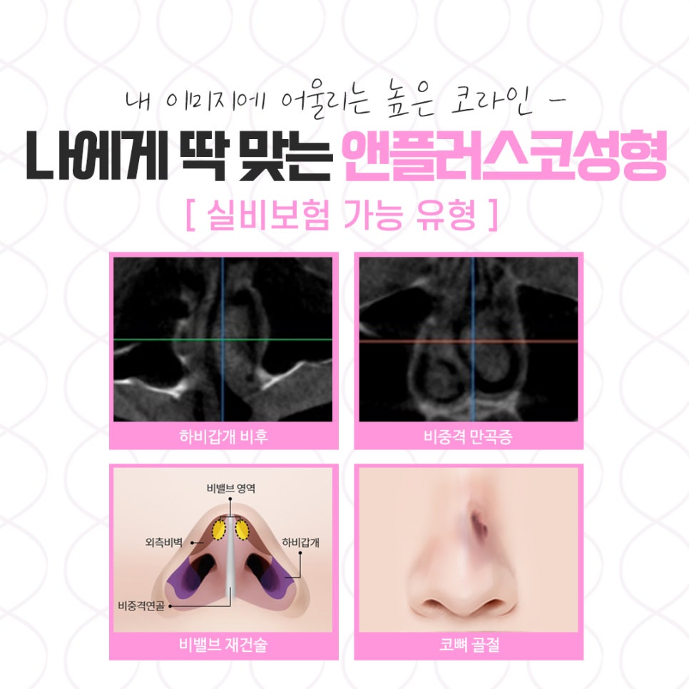 코뼈골절 정확한 진단으로 관련 이미지 4